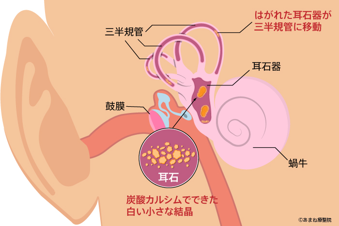 4. 低血糖症です